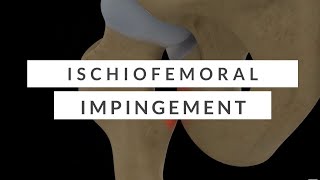 Ischiofemoral Impingement  A Nonsurgical Overview [upl. by Toombs]