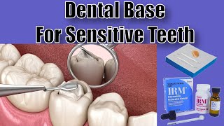 Dental Bases  Mixing and Placement  Dental Assisting 101 [upl. by Donoho]