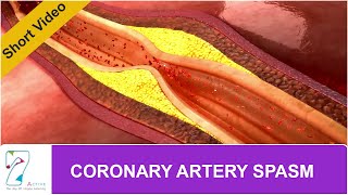 CORONARY ARTERY SPASM [upl. by Latif]