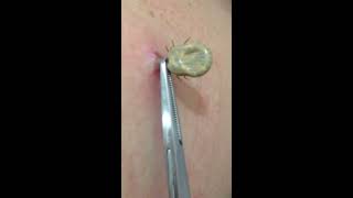 Tick removal by US doctor [upl. by Olivette]