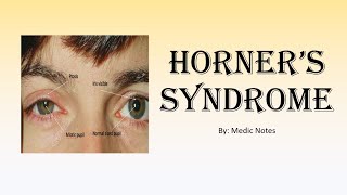 Horner syndrome [upl. by Humfrey]