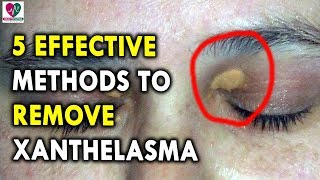 5 Effective Methods to Remove Xanthelasma  Best Health Tips for CHRONIC DISEASES [upl. by Nnylrac919]