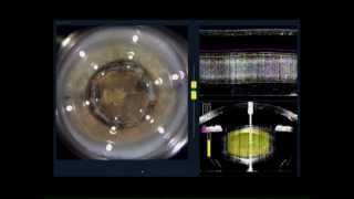 Femto laser Cataract surgery ReStor T LenSx Part 1 Laser treatment [upl. by Rosemari]