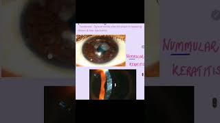 Nummular keratitis cornea keratitis eyes ophthalmology [upl. by Dun]