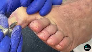 CHIROPODY procedure and extract HELOMA FULL PROCEDURE [upl. by Vanessa509]