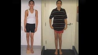 Limb Lengthening Patient Story Jacob [upl. by Akeyla]