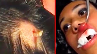 Huge Larva Pulled Out Of Ladys Scalp and Lip [upl. by Wichern]