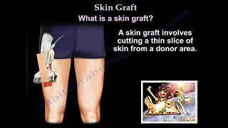 Skin Graft  Everything You Need To Know  Dr Nabil Ebraheim [upl. by Lidstone]