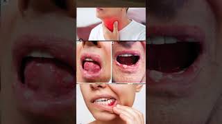 Betadine gargle use in hindi  betadine gargle  Povidone iodine gargle how to use viral shorts [upl. by Larual]