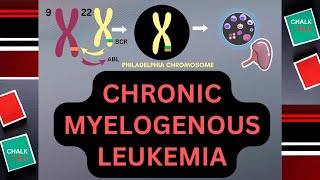 CHRONIC MYELOGENOUS LEUKEMIA CML [upl. by Yeslrahc238]