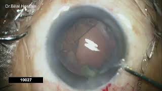 Mellifluous management of cataract surgery by Phacoemulsification  Dr Billal Hossain [upl. by Keenan407]