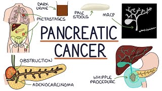 Understanding Pancreatic Cancer [upl. by Willcox]