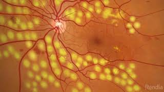 Diabetic Retinopathy Panretinal Photocoagulation [upl. by Htebarual618]