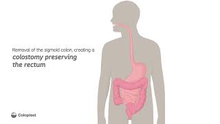 Creation of end colostomy by removing sigmoid colon  Ostomy surgery  Coloplast India [upl. by Namielus]