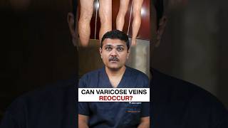 Varicose Vein EXPERT Reveals the Truth About Recurrence [upl. by Agler]