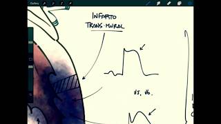 ECG Trazos de isquemia y necrosis  SCASEST vs SCACEST [upl. by Rosalie]