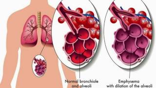 Difference Between Asthma and Bronchitis [upl. by Ethban]