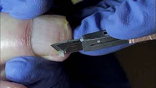 DIY Ingrown Toenail Removal  How to Safely Cut Ingrown Toenails at Home [upl. by Neelrihs]