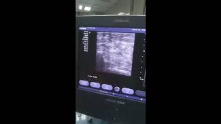 Ultrasound guided ulnar nerve block [upl. by Carline820]