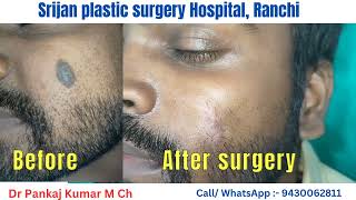 Birthmark Removal Birthmark Removal with surgery  laser treatment by Dr Pankaj Kumar [upl. by Enomed701]