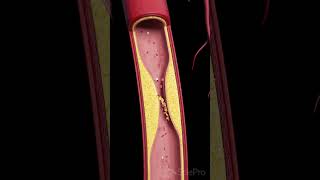 Atherosclerosis The Silent Build UpFollowAtherosclerosis occurs when fatty deposits [upl. by Anigroeg]