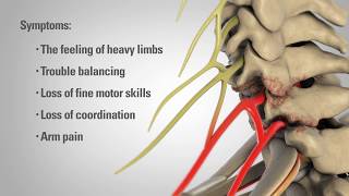 Cervical Laminectomy  Patient Education [upl. by Tarr650]