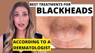 Blackheads Dermatologist Shares Best Treatments to Remove Them with Affordable Skincare Options [upl. by Atnom]