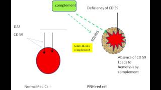 Paroxysmal Nocturnal Hemoglobinuria [upl. by Herriott]