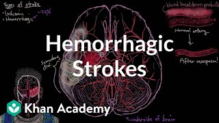 Hemorrhagic strokes  Circulatory System and Disease  NCLEXRN  Khan Academy [upl. by Eet]