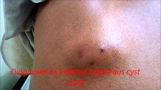 infected sebaceous cyst back [upl. by Llenrag]