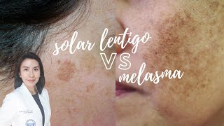 Whats the difference Solar Lentigo vs Melasma [upl. by Alexandra749]