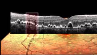 SPECTRALIS® Imaging Modalities SD OCT Red Free Infrared BluePeak ICG FA Scanning Heidelberg [upl. by Dorolice]