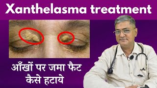 Xanthelasma Eye cholesterol kam karne ke upay  eye cholesterol treatment  Xanthelasma removal [upl. by Nore728]