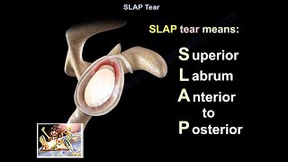 SLAP Tear  Everything You Need To Know  Dr Nabil Ebraheim [upl. by Painter]