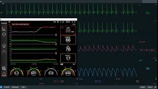 HPI case study 3  vasopressor therapy [upl. by Loos]