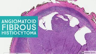 Angiomatoid Fibrous Histiocytoma 101 Note its NOT aneurysmal dermatofibroma [upl. by Nauh]