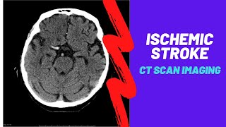 Imaging of Ischemic Stroke For Medical students residents and clinicians [upl. by Yekcir282]