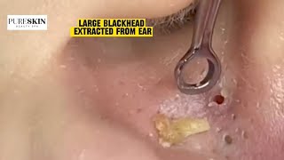 LARGE BLACKHEAD EXTRACTED FROM EAR  PURESKIN Beauty Spa Reacts Dr Dona Cravos asmr [upl. by Domph394]