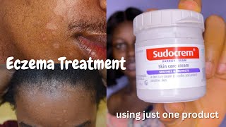 Eczema Treatment  How to Get Rid of Eczema using Sudocrem [upl. by Narot278]