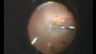 Vitrectomy for dropped lens fragments [upl. by Gagne]