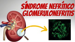 Síndrome Nefrítico  Glomerulonefritis Explicados Claramente [upl. by Jerroll]