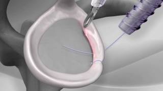 Knotless Shoulder Labral Repair with Arthrex® PushLock® [upl. by Akinuahs]