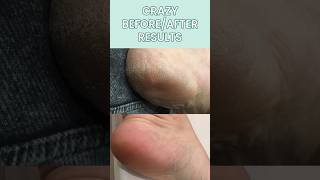 Dermatologist Reacts to crazy BeforeAfter with the Plantifique Foot Peel Mask shorts footmask [upl. by Pope]