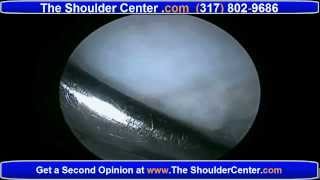 ReInjury after Rotator Cuff Surgery and How to Recover [upl. by Fronia252]