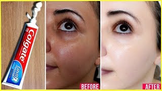 Apply Toothpaste on Your Skin and See Magical Result within 1 Hour ¦Amazing Toothpaste Beauty Hacks [upl. by Tterraj377]