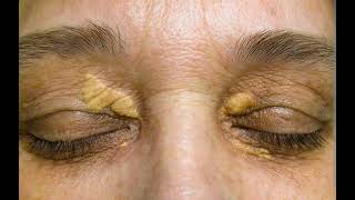 Peel for Xanthelasma [upl. by Oirevlis]