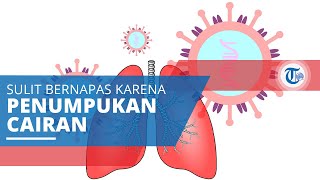 Edema Paru Gejala Sulit Bernapas akibat Terjadinya Penumpukan Cairan di dalam Kantong Paruparu [upl. by Alegnasor]