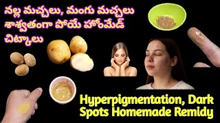 How To Get Rid Of Pigmentation Home Remidies  ఏ మంగు మచ్చలైనా ఇంట్లోనే పోగొట్టచ్చు ArunasMagazine [upl. by Einyaj]