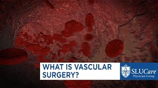 What is Vascular Surgery [upl. by Onabru]