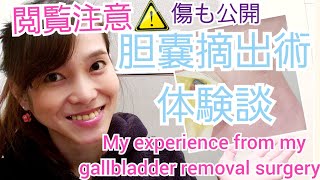 My experience from my gallbladder removal surgery 胆嚢摘出術の体験談 [upl. by Arte]